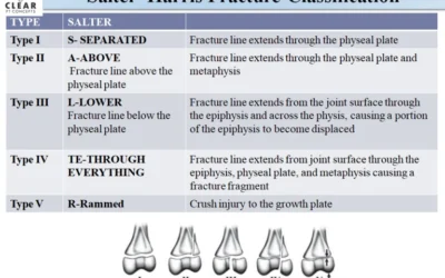 Salter–Harris Fracture Classification